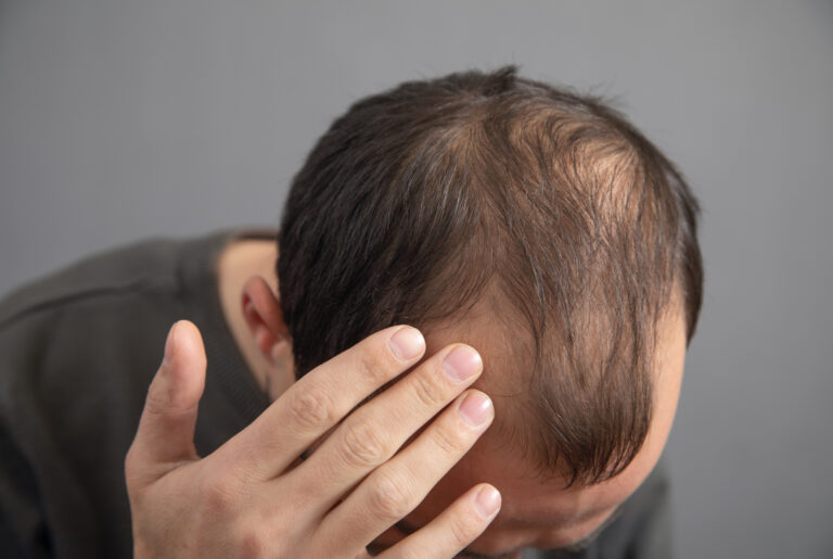Balding man holding his hand to his head, representing hair restoration