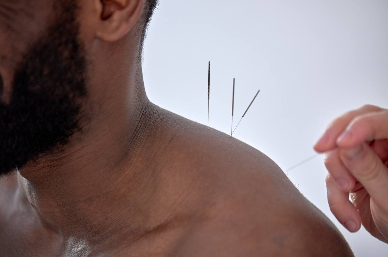 Chinese Medicine and Breema 1 Man with acupuncture needles on left shoulder