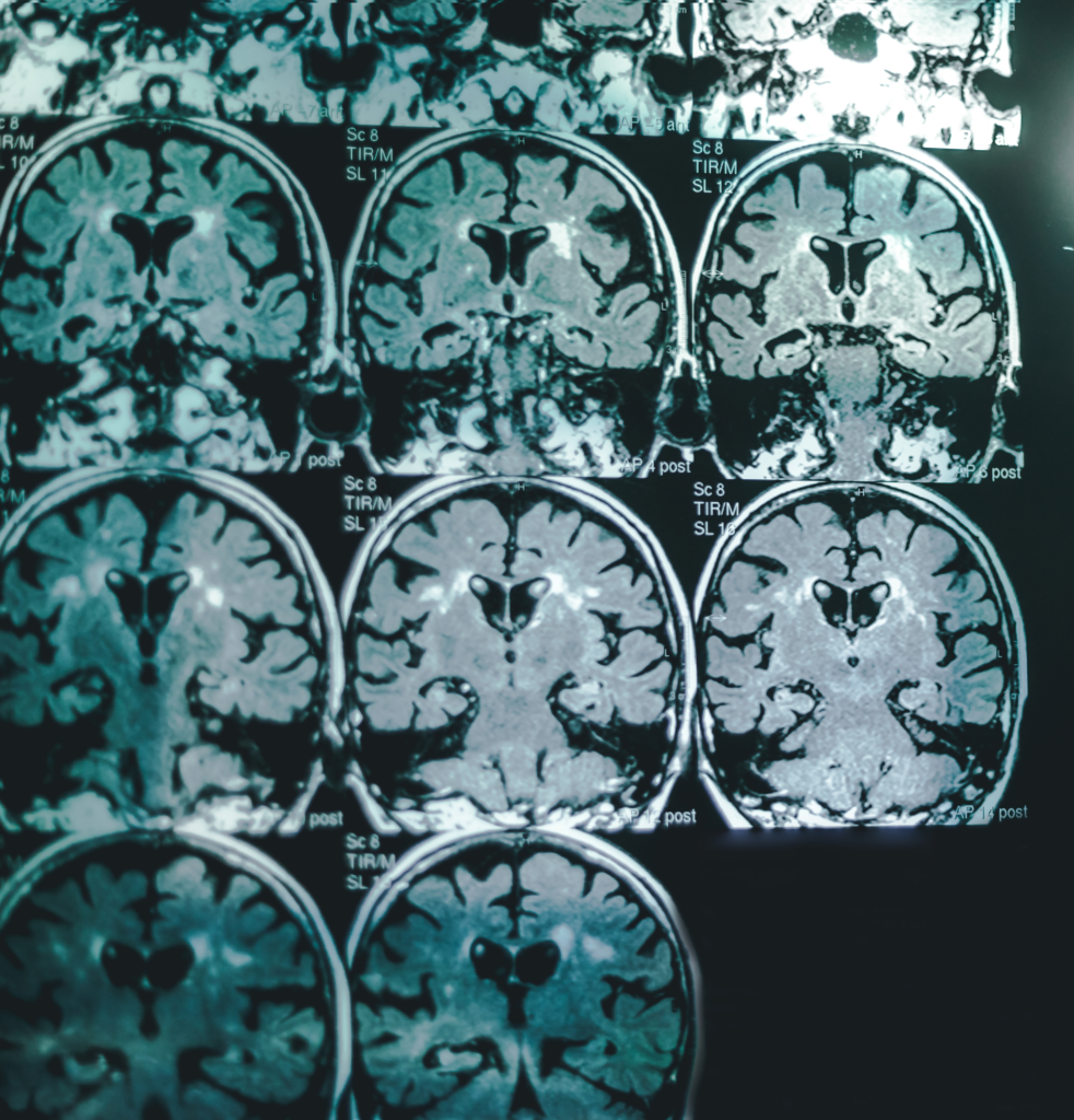 Therapeutic Plasma Exchange for Alzheimer's | Lifespan Health 2 MRI scan of brain, representing Therapeutic Plasma Exchange for Alzheimer's